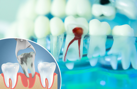 root canal treatment vs tooth extraction