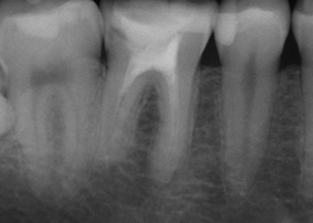 root canal re-treatment