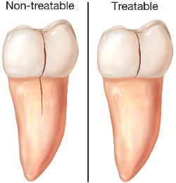 Cracked Tooth Diagnosis in North York, Ontario