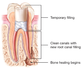 root canal retreatment