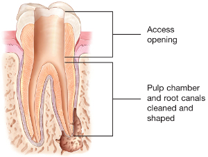 opened root canal