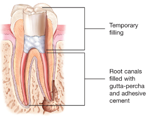 North York, root canal filling