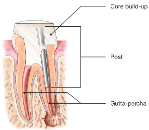 Post Root canal